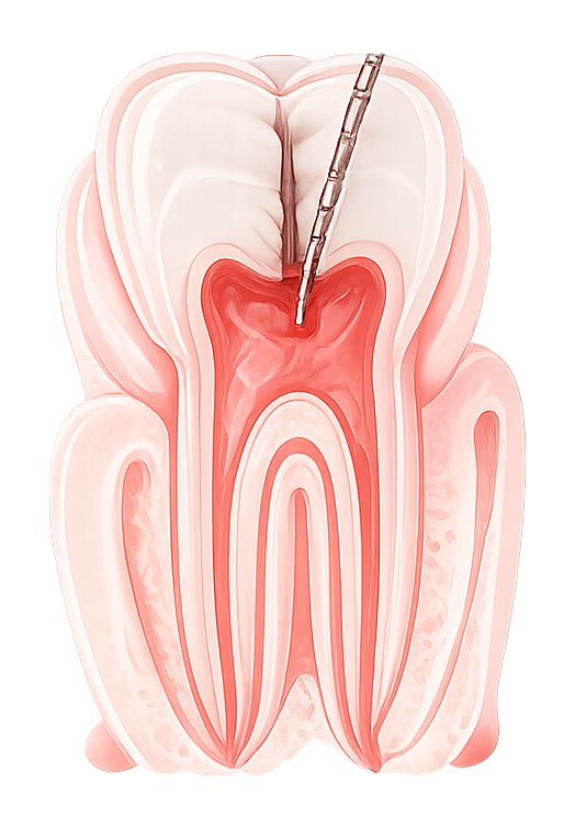 Root Canal Treatment